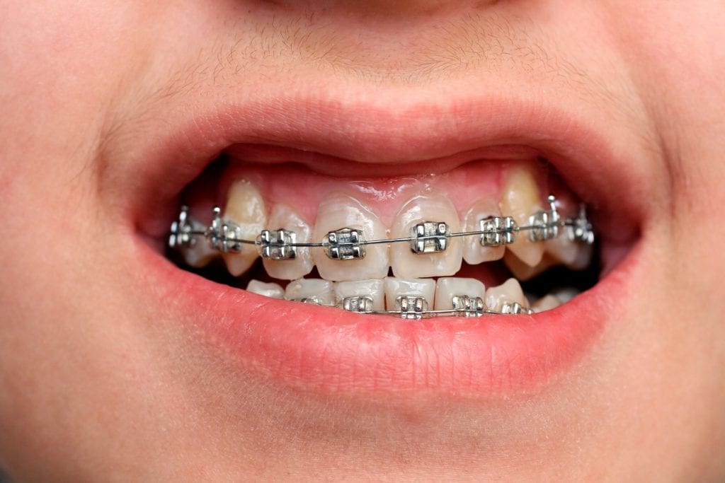 cost teeth effect bands